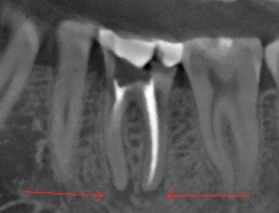 cone scan ct   (CBCT)