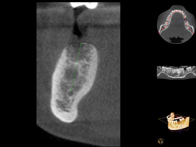 CBCT for implant planning