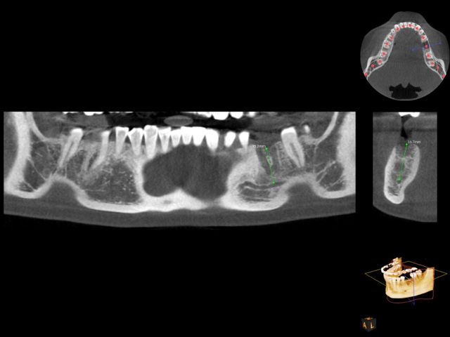 CBCT of missing tooth