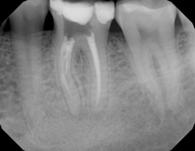 complication with root canal