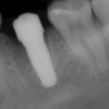 Dental implant placement