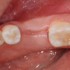 Tooth extraction site