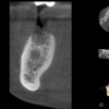 CBCT for implant planning