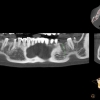 CBCT of missing tooth