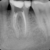complication with root canal