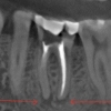 cone scan ct   (CBCT)
