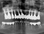 Multiple implants for support of a fixed bridge