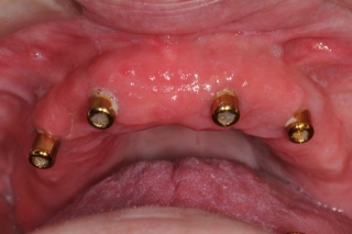 upper jaw dental implants for overdenture