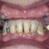 extraction of decayed teeth