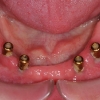 Lower jaw dental implants for overdenture