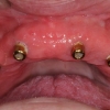 upper jaw dental implants for overdenture