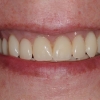 Cosmetic results with a new smile