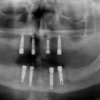 xray of dental implants