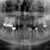 Xrays for decayed teeth