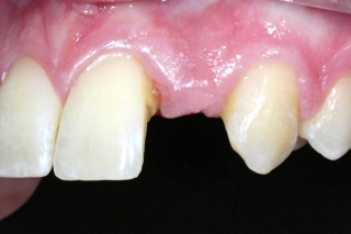 Missing lateral incisor- before implant placement