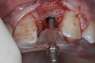 dental implant placement
