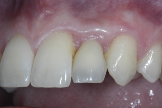Provisional restoration