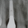 Implant for missing lateral incisor