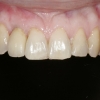 Final crown on dental implant