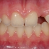 Missing lateral incisor #10