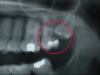 Tooth decay from wisdom tooth
