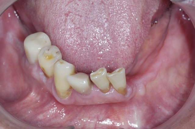 Lower teeth decay and gum disease