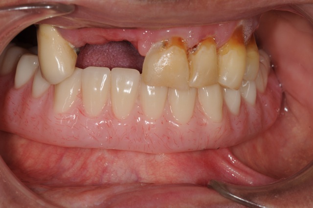 Overdenture with four implants