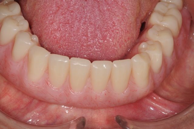 Final overdenture on four dental implants