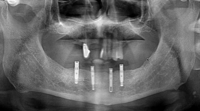X-ray with dental implants
