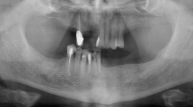 X-ray- lower teeth with gum disease and decay