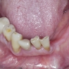 Lower teeth decay and gum disease
