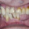 gum disease and tooth decay with extraction and immediate implants