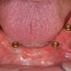 Four immediate dental implants