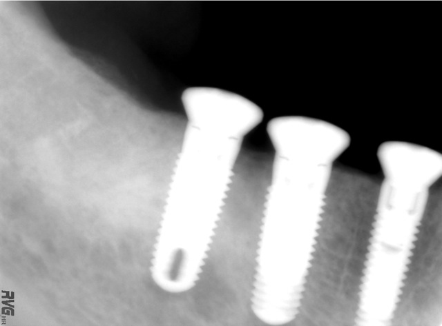 X-ray of three adjacent implants
