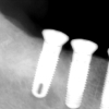 X-ray of three adjacent implants