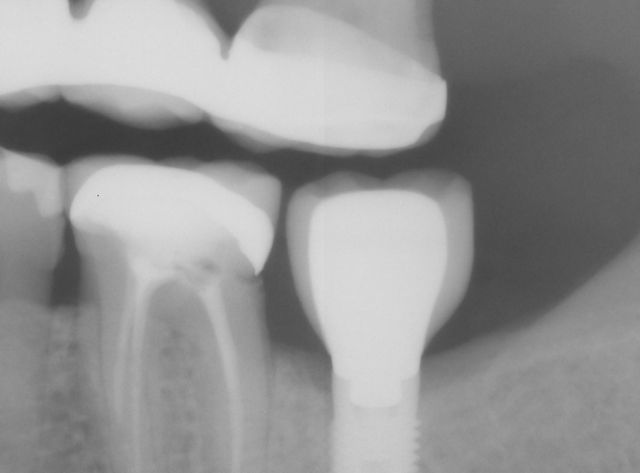 Patient A- Single lower molar