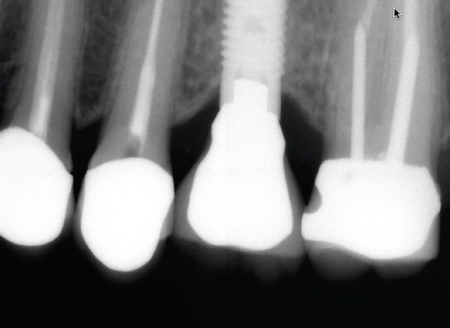 Patient B- Single upper molar