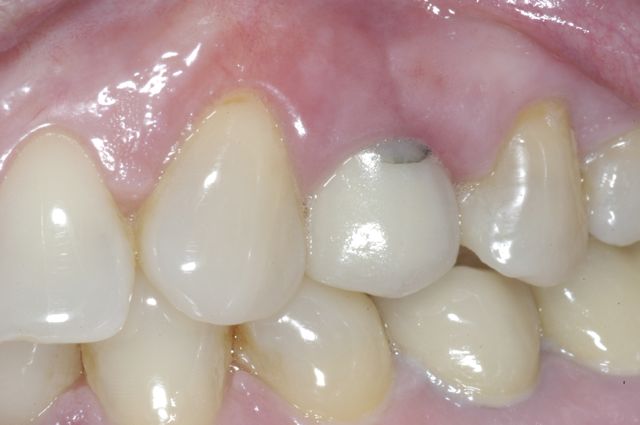 Patient D- Upper single premolar