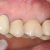 Patient B- Single upper molar