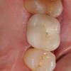 Patient C- Upper single molar