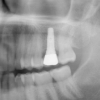 Patient C- Upper single molar