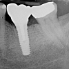X-ray showing final implant and crown