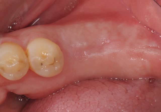 Missing lower teeth- molars