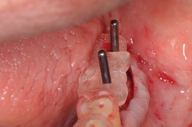 Surgical guide for dental implant placement