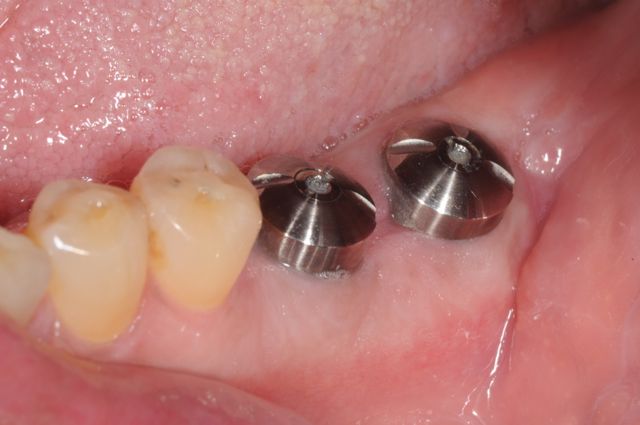 Dental implants healed