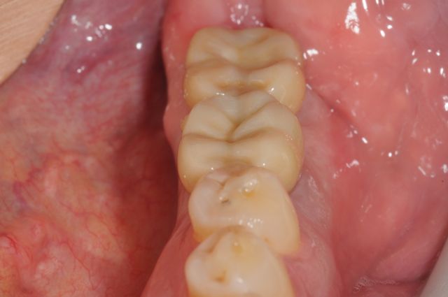 Lower dental implants restored with single crowns