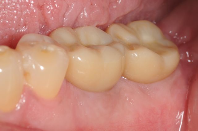 Final crowns on dental implants