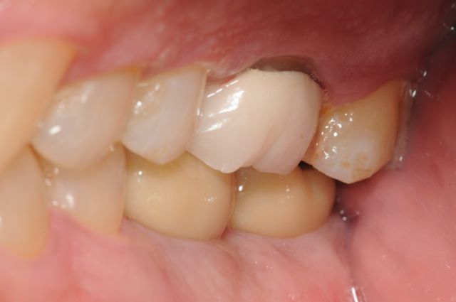 Final bite of implant crowns