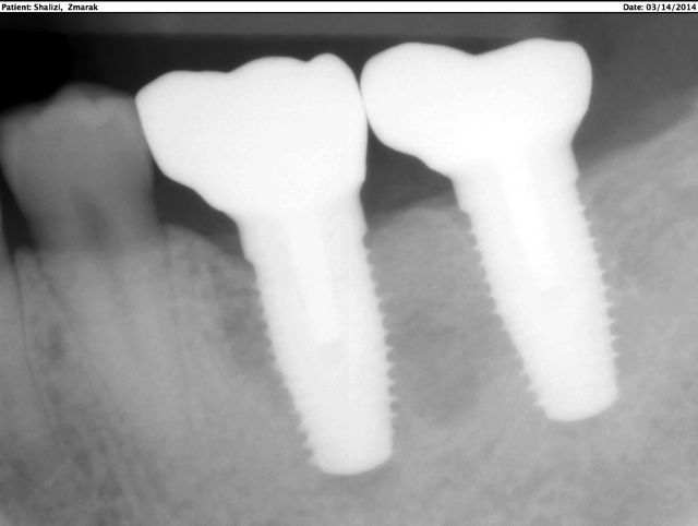 Final X-ray of crowns on implants