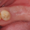 Missing lower teeth- molars